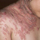 Illustration for article titled Bagaimana Cara Mengatasi Penyakit Herpes